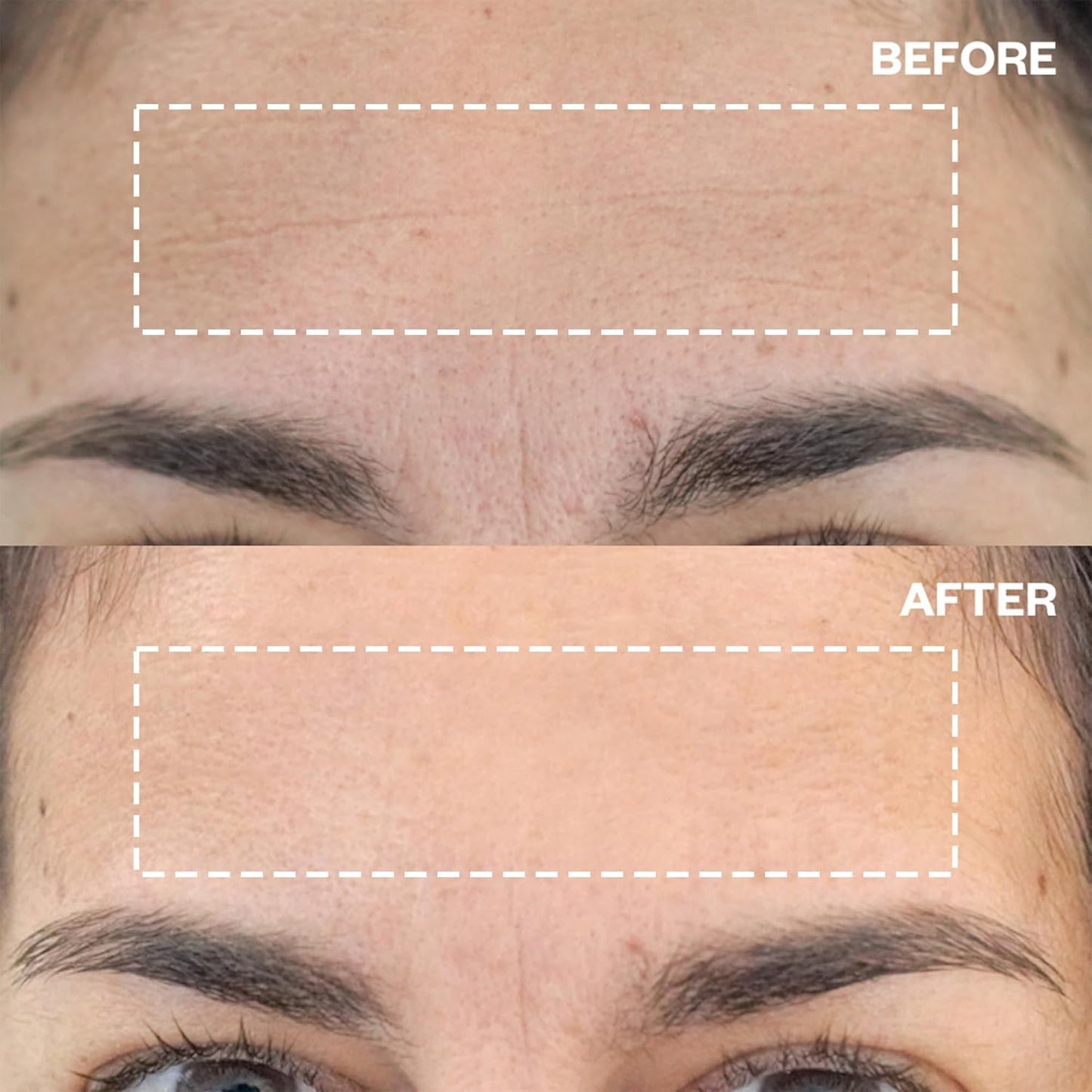 Wrinkles Schminkles Forehead Wrinkle Patches, 4-Pack, Reusable Hypoallergenic Silicone Smoothing Pads for Reducing Frown Lines & Face Lift Overnight