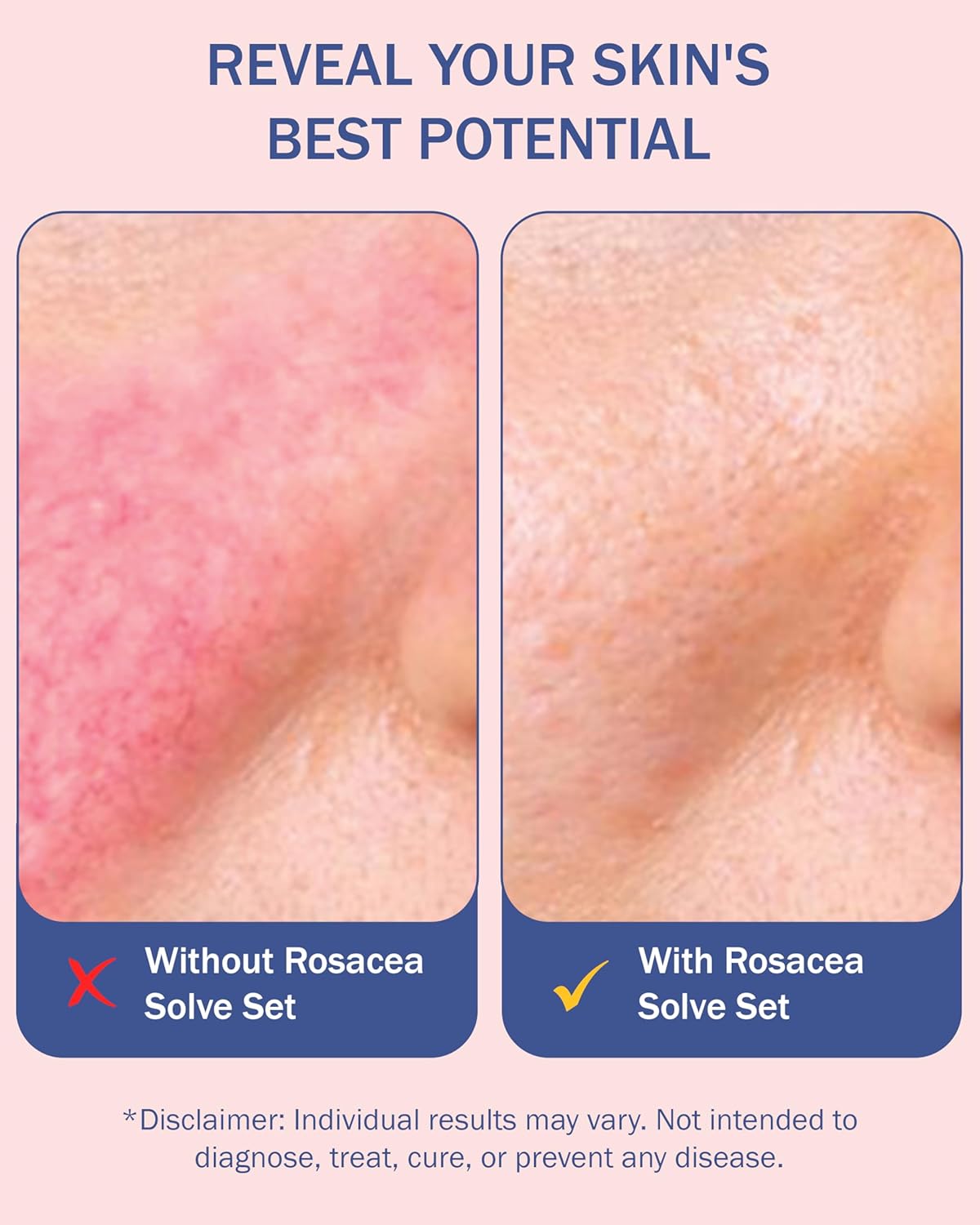 Rosacea Treatment Skincare for Women & Men - Face Wash, Rosacea Cream & Face Serum, Moisturizer Redness Reducing Skin Care with Aloe Vera, Hyaluronic Acid & Fruit Extracts, Made in USA by e70