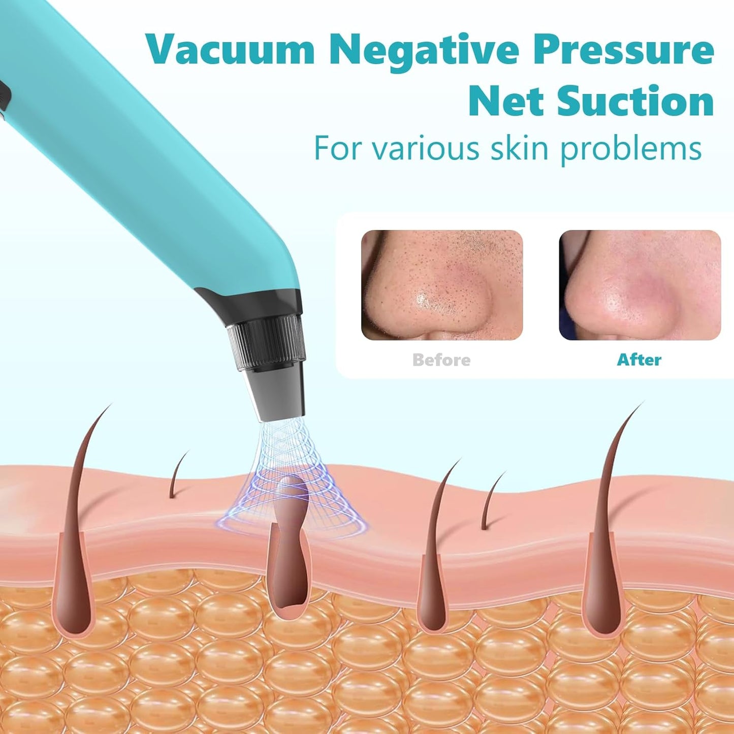 Blackhead Remover Vacuum - Black Head Remover for Face,Blackhead Extractor Tool with 3 Adjustable Suction Levels,4 Probes,USB Interface Type Pore Vacuum,Suitable for Women and Men (Blue)