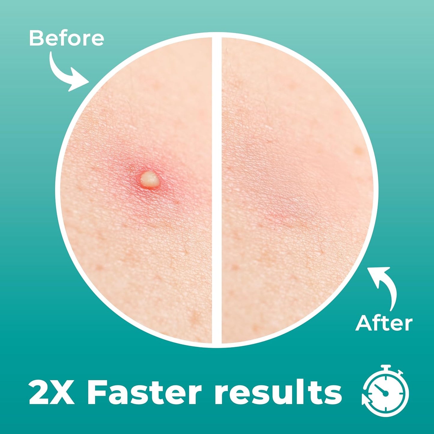 Pimple Patches for Nose (12 Pack), Cover Nose Pimples Overnight - Hydrocolloid Acne Patches - Pimple Patch Hydrocolloid Patches & Pimple Stickers, Nose Strip, Zit Patches